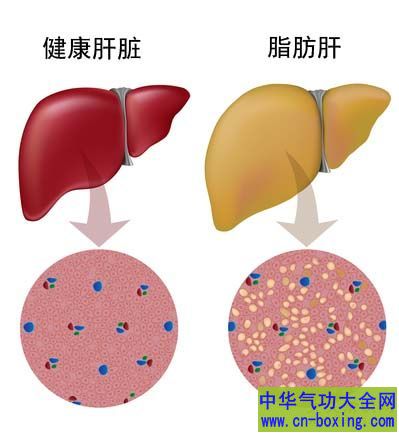 年轻人也脂肪肝 保肝有妙招