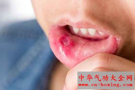 口腔溃疡