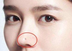 脸上有痣的人好不好？代表什么？